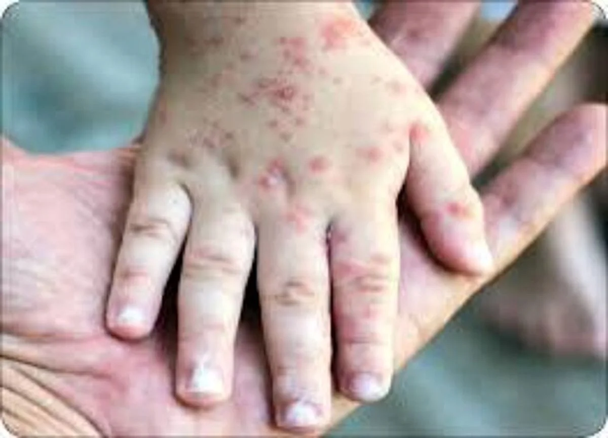 هشدار درباره موج تازه آبلهمرغان در بهار+ علائم، دوره سرایت و نکات حیاتی مراقبت