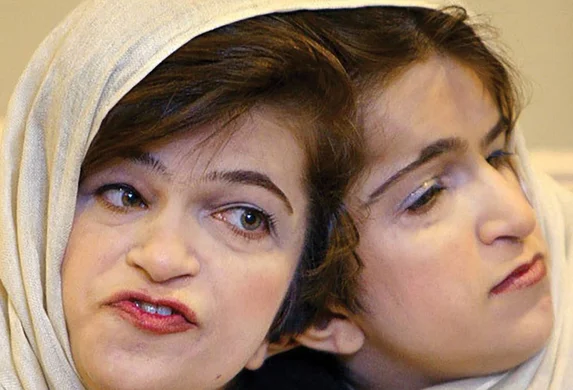 بیوگرافی لاله و لادن; خواهرانی با دو مغز و یک قلب + عکس مزار