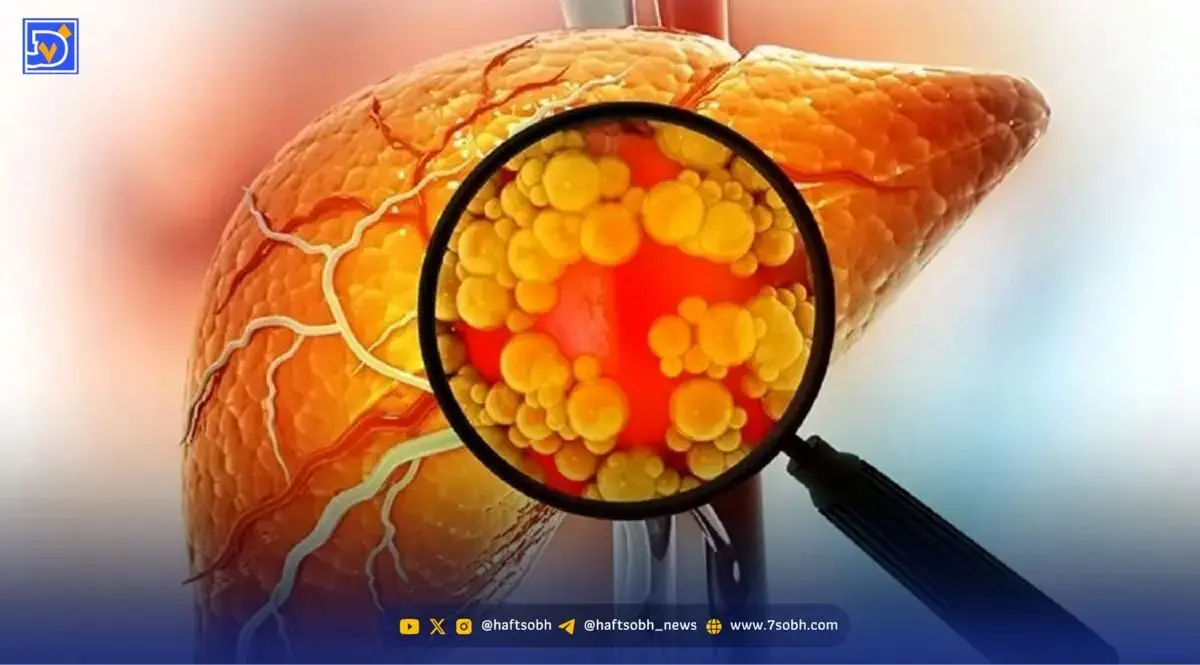 کبد چرب بیصدا شما را از پای در می آورد
