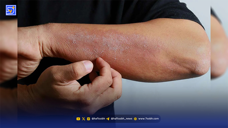 بهترین دارو برای خارش بدن؛ از آنتیهیستامینها تا درمانهای موضعی