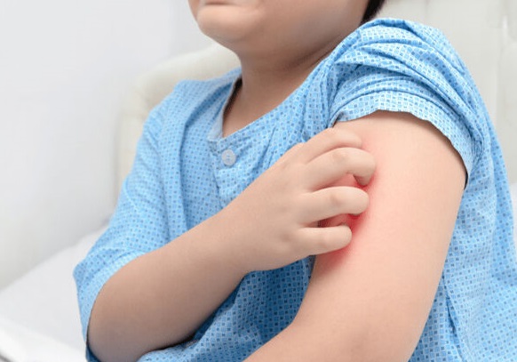 بهترین دارو برای خارش بدن کودکان