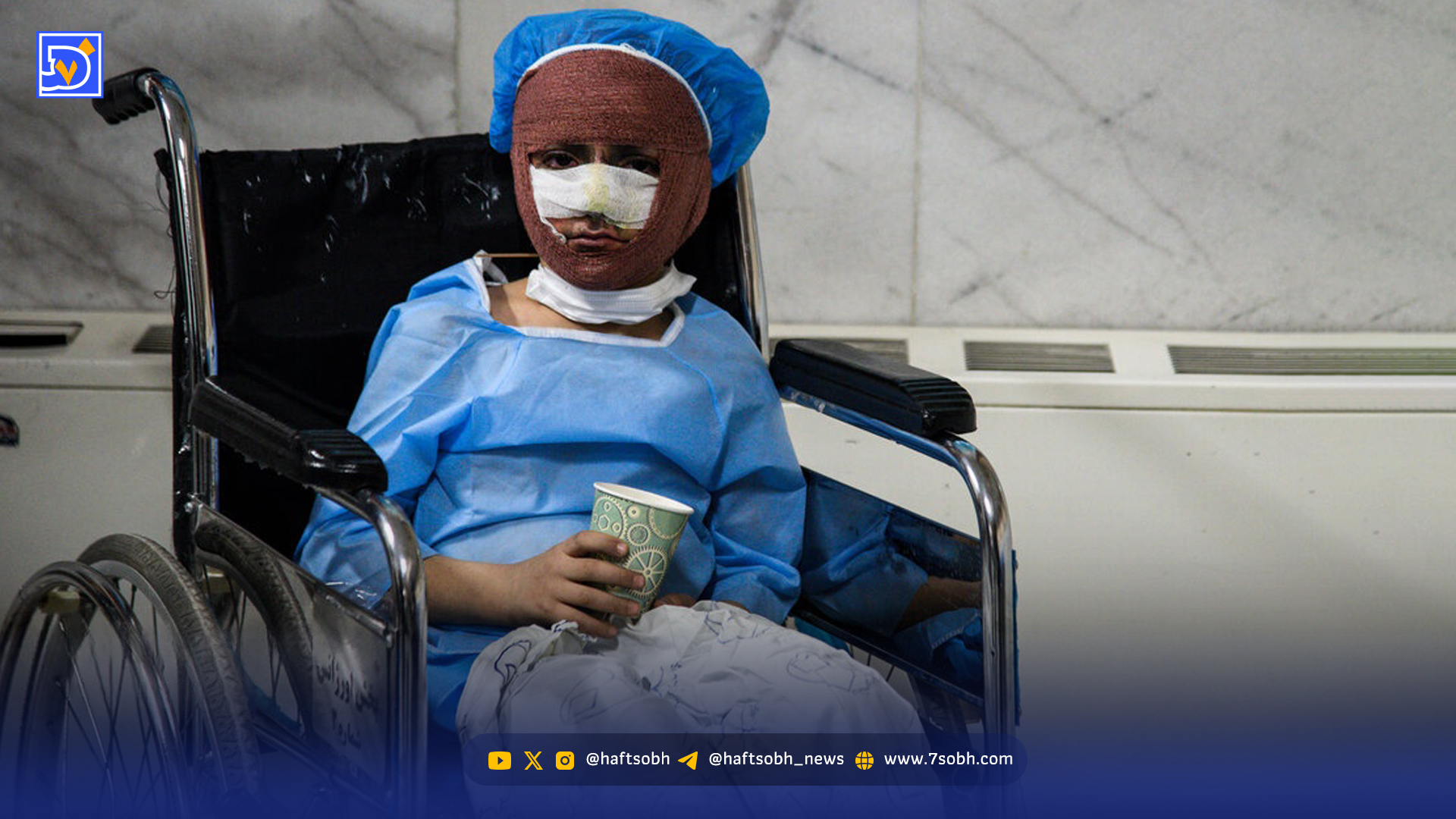 نرخ سوختگی در ایران ۸ برابر میانگین جهان