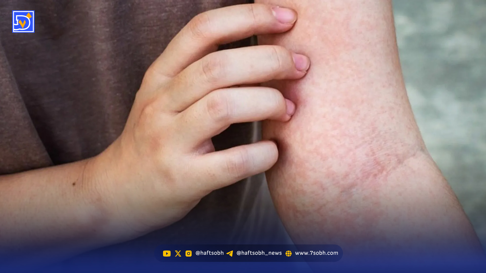 بهترین دارو برای خارش بدن